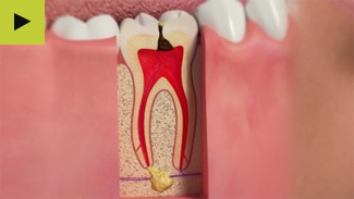 Tooth Decay Detection